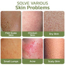 Crema liscia e detergente profonda per cheratosi della luna meridionale