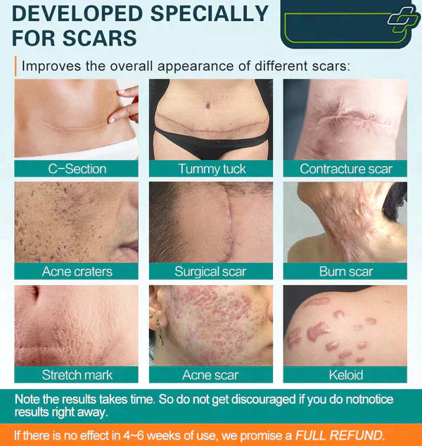 LOVILDS™ Advanced Scar Spray for all types of scars