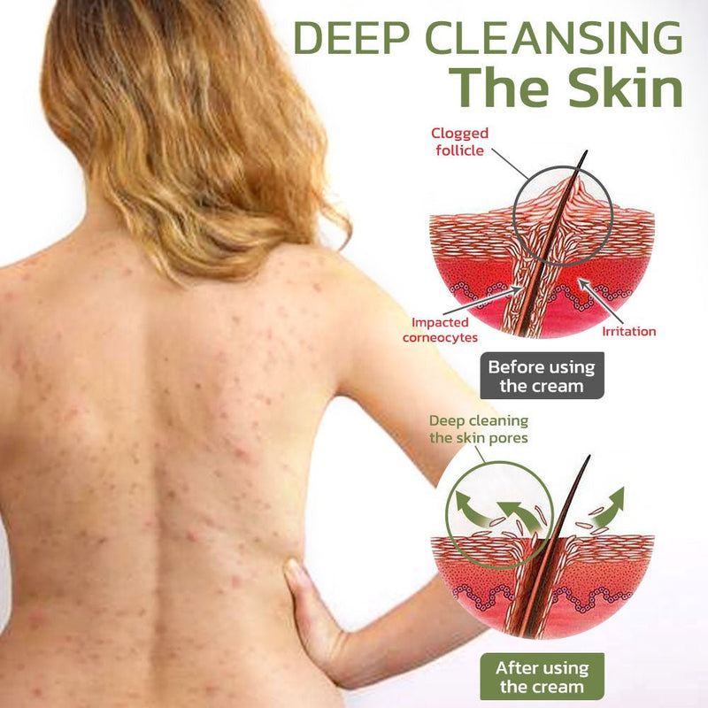 South Moon KeratosisTreat Deep Clean Smooth Cream